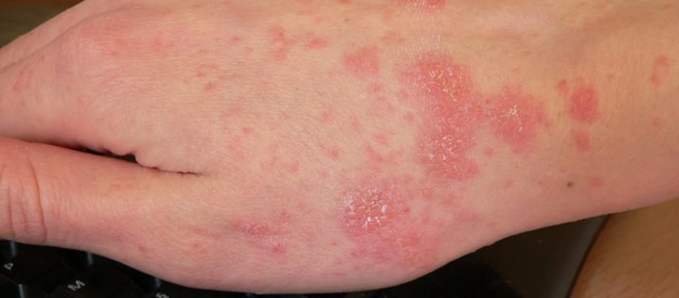 Ψώρα ή ψωρίαση; - Οι διαφορές στα συμπτώματα για να καταλάβετε τι έχετε